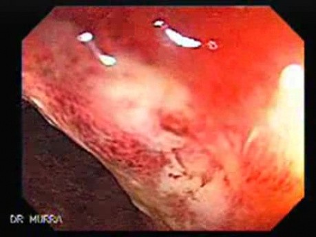 Colitis Ulcerosa - Pancolitis (1 of 7)