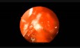 Traumatic Optic Neuropathy - Endoscopic Decompression
