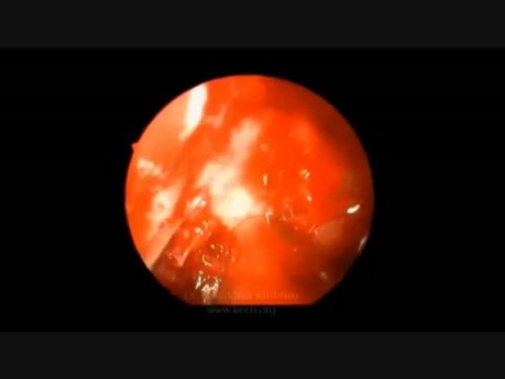 Traumatic Optic Neuropathy - Endoscopic Decompression