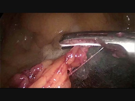Laparoscopic Left Hemicolectomy for Colocolic Intussusception due to Intraluminal Lipoma