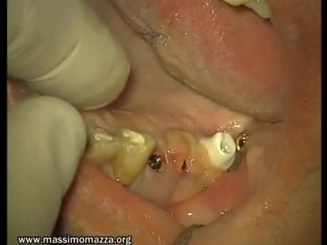 Loading Of Early Prosthesis 16-17-25-26-27 (1/3)