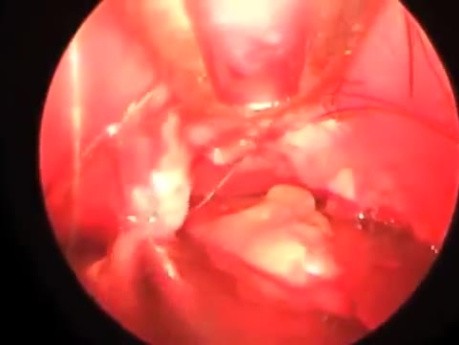 Endoscopic Removal of Forehead Lipoma