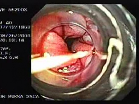 Acute Variceal Bleeding - Suction of Varix