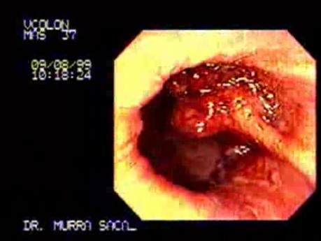 Stalk Villous Adenoma (1 of 2)