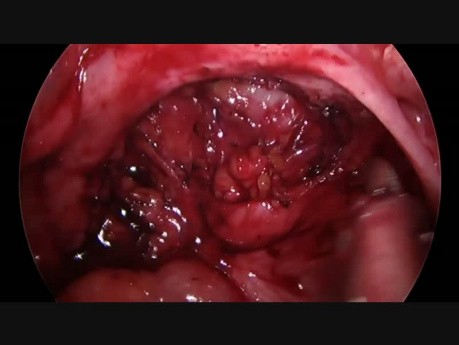 Partial Thickness Resection of Rectal Endometriosis