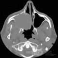 Giant Maxillary Sinus Mucocele [CT scan – axial view]