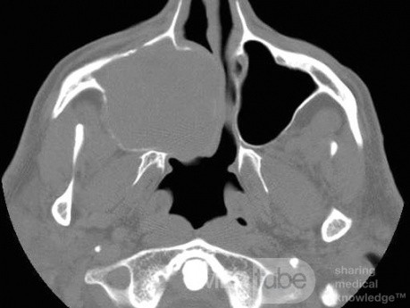 Giant Maxillary Sinus Mucocele [CT scan – axial view]
