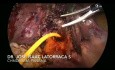 Laparoscopic T tube in Mirizzi Syndrome type IV 