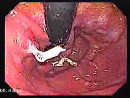 Longstanding gastroesophageal reflux disease (1 of 7)