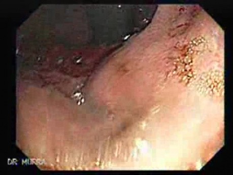 Gastric Adenocarcinoma That Has Been Manifested With Hiccups (3 of 5)