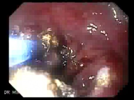 Debulking Of The Esophageal Tumor - Plasma Argon Coagulation