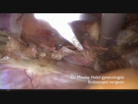 Laparoscopic Morcellation Instrument for Big Uterus