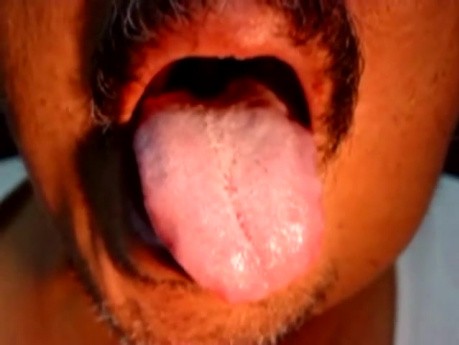 Fasciculations of A Tongue