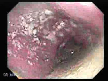 Esophageal Achalasia - 32 Years Old Patient