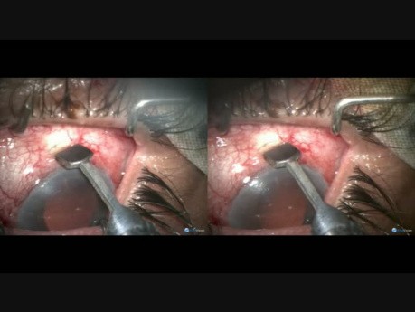 Complicated Aphakic Glaucoma. Microtrack at 6 O'clock