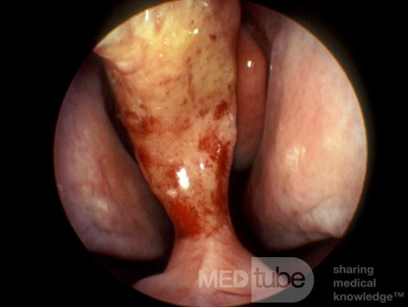 Large Nasal Septal Perforation