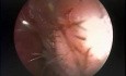 Frontal Sinus Mucocoele - Endoscopic Treatment