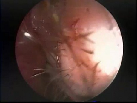 Frontal Sinus Mucocoele - Endoscopic Treatment