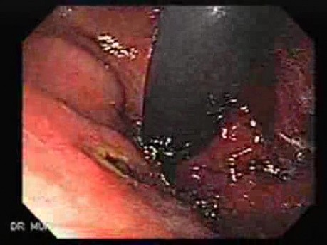 Ulcerative Gastric Varix - Endoscopy
