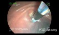 Endoscopic Treatment of Impacted Stone in the Vater Papilla