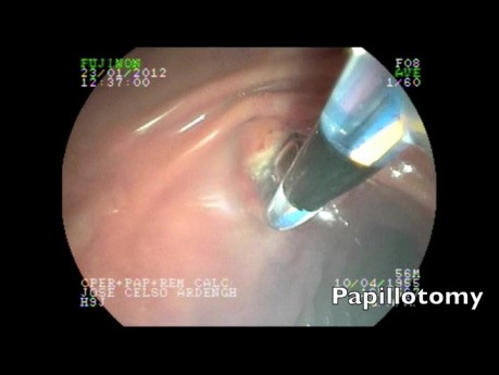 Endoscopic Treatment of Impacted Stone in the Vater Papilla