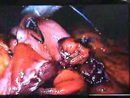 Jejunal Gastrointestinal Stromal tumor (GIST) (49 of 86)