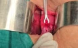Tubal Recanalization with Minilap Incision