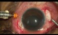 Post Trauma Endophthalmitis Recovery from No PL