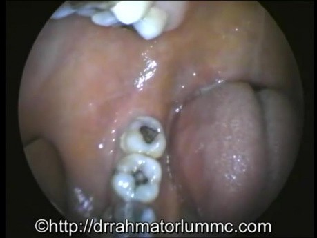 Oropharynx examination