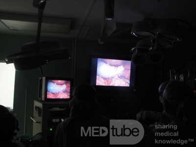 Gastric Ulcerated Adenocarcinoma of the Pre-pyloric Antrum (6 of 28)