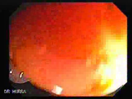 Familial Adenomatous Polyposis (11 of 36)