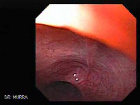 Esophageal Mucosal Bridge - 80 Years-Old Female