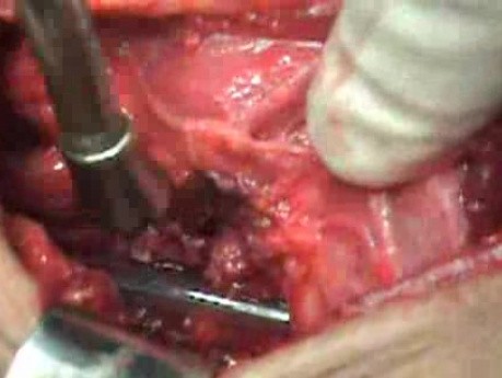 Perforation of a Esophageal Carcinoma After the Procedure with Hydrostatic Balloon Dilation - Beginning of the Surgery