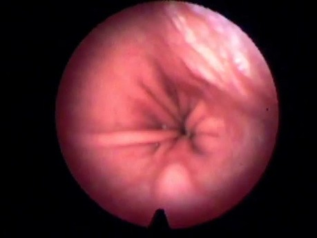 Esophagoscopy as a Diagnostic Method for Candidiasis