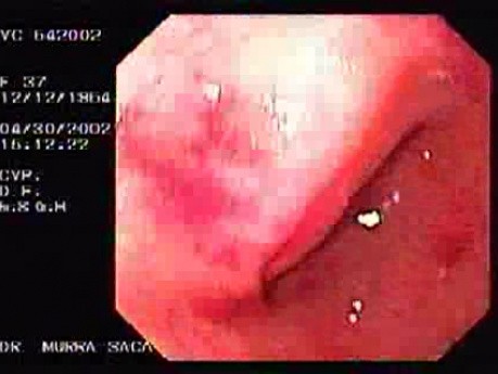 Collagenous Colitis