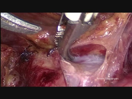 Laparoscopic Pelvic and Aortic Lymphadenectomy