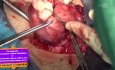 Cornoplasty