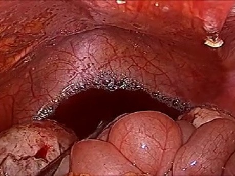 Laparoscopic Surgery for Ovarian Endometrioma