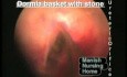 Ureteral Stone- Removal Of The Stone
