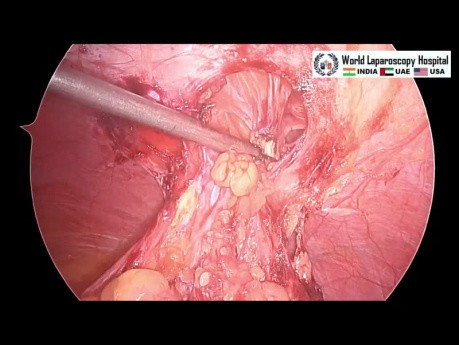 Single Instrument Dissection of Laparoscopic Incisional Hernia Repair