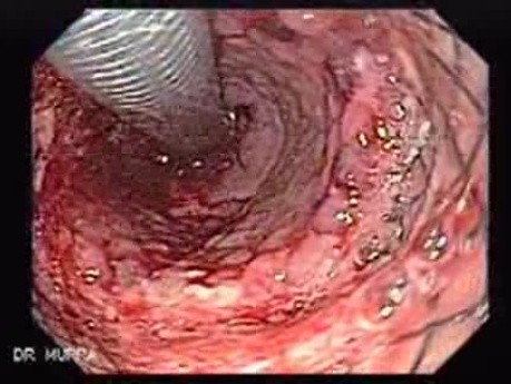 Placement Of The Esophageal Stent - 3/12