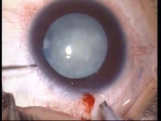 Phacoemulsification 