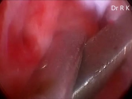 Hysteroscopy for Asherman Syndrome and Diagnostic Laparoscopy