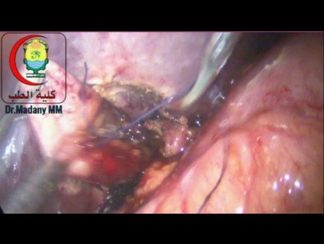 Accidental GB Perforation During Lap Chole