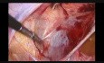 Uterine Artery Ligation