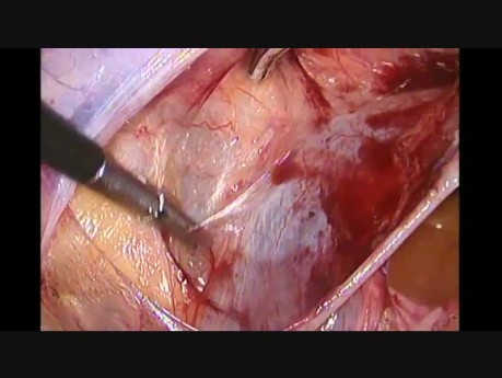 Uterine Artery Ligation