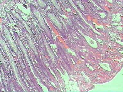 Case on Multiple Adenomas (large polyps) of the Rectum (36 of 37)