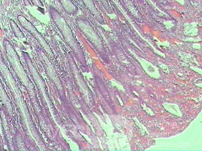 Case on Multiple Adenomas (large polyps) of the Rectum (36 of 37)