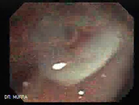 Polyp Inside Of A Diverticulum (1 of 12)