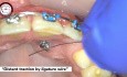 Treatment of Impacted Canine, Step by Step Piggyback Double Wire Mechanics